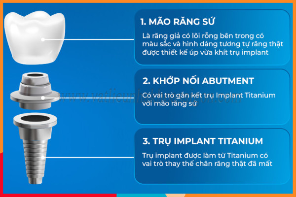 9 thiết bị cấy ghép răng được sử dụng trong quy trình trồng răng Implant